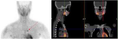 An Atypical Presentation of Primary Hyperparathyroidism in an Adolescent: A Case Report of Hypercalcaemia and Neuropsychiatric Symptoms Due to a Mediastinal Parathyroid Adenoma